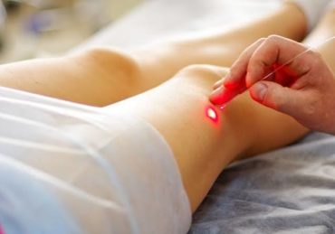 Laser endoveineux